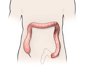 Anterior Resection