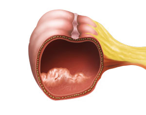 Colorectal Cancers