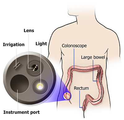 Colorectal Cancers