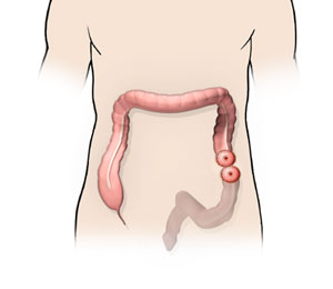 Colostomy