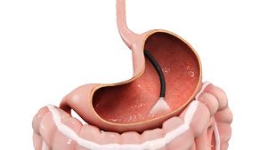 Gastroscopy