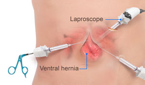 Hernia Repair Surgery