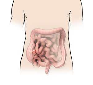 Ileostomy