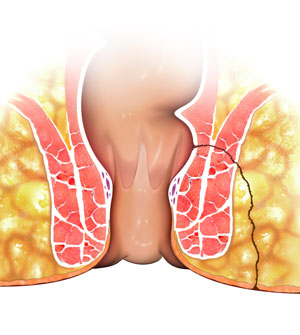 Perianal Fistulae