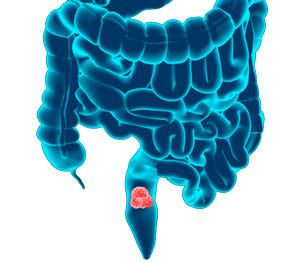 Bowel Cancer