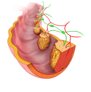 Recurrent Colon Cancer