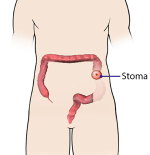 Stoma